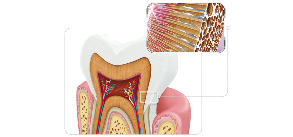 hipersensibilidade do dente